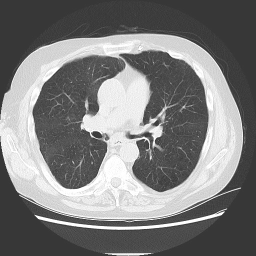 Bronchial stenosis - lung transplant (Radiopaedia 73133-83848 Axial lung window 30).jpg