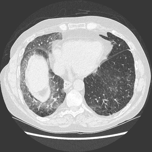 File:Bronchial stenosis - lung transplant (Radiopaedia 73133-83848 C 10).jpg