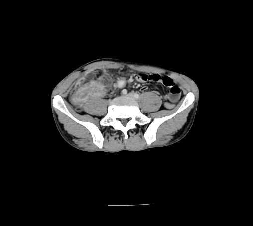 File:Bronchiectasis in Crohn disease (Radiopaedia 60311-67977 B 118).jpg