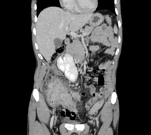 File:Bronchiectasis in Crohn disease (Radiopaedia 60311-67977 C 27).jpg