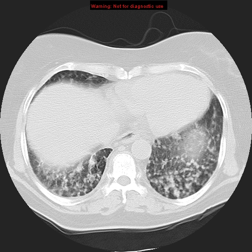 File:Bronchoalveolar carcinoma (Radiopaedia 13224-13233 Axial lung window 33).jpg