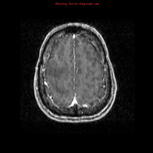 File:Bronchogenic carcinoma brain metastasis (Radiopaedia 9286-9969 Axial T1 C+ 21).jpg