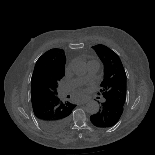 Bronchogenic carcinoma with metastatic lymphadenopathy (Radiopaedia 37671-39569 Axial bone window 29).jpg