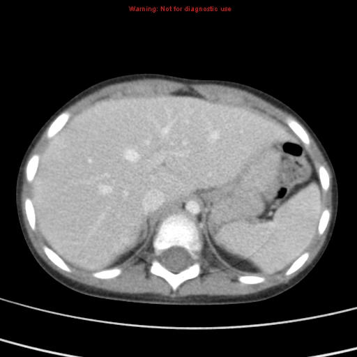 File:Bronchogenic cyst (Radiopaedia 9372-10063 C 25).jpg
