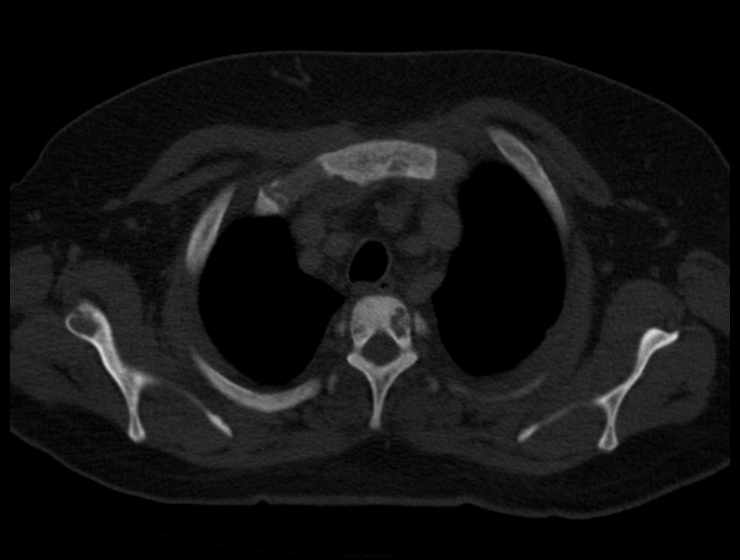 Brown tumors compressing the spinal cord (Radiopaedia 68442-77988 Axial bone window 13).jpg