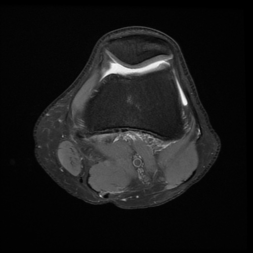 File:Bucket-handle meniscus tear (Radiopaedia 65700-74809 Axial PD fat sat 10).jpg