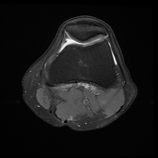 File:Bucket-handle meniscus tear (Radiopaedia 65700-74809 Axial PD fat sat 11).jpg