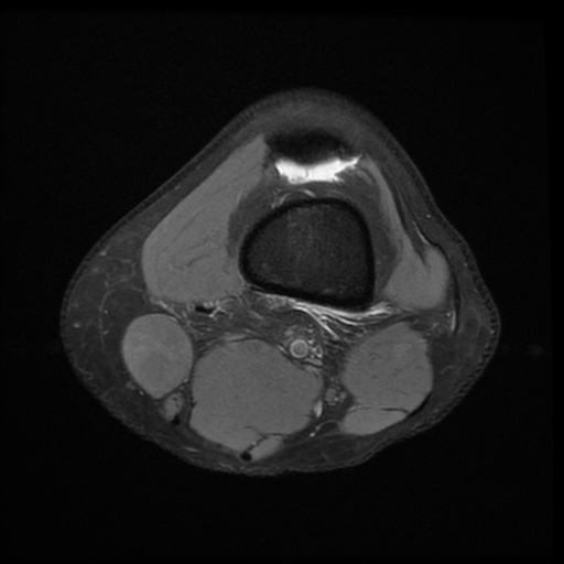 File:Bucket-handle meniscus tear (Radiopaedia 65700-74809 Axial PD fat sat 5).jpg
