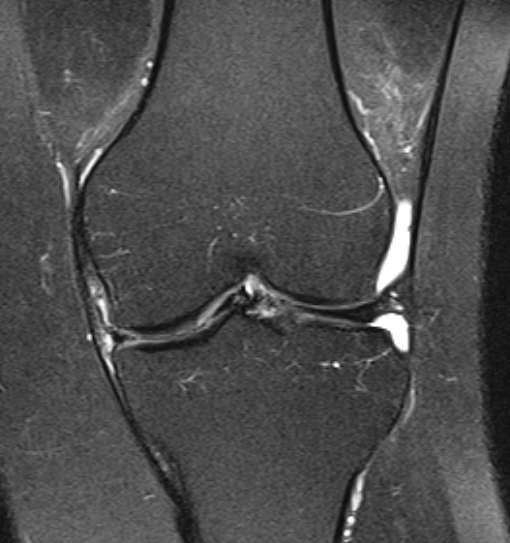 File:Bucket handle tear - medial meniscus (Radiopaedia 79028-91942 Coronal PD fat sat 11).jpg