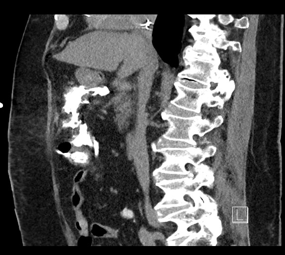 Buried bumper syndrome - gastrostomy tube (Radiopaedia 63843-72577 Sagittal Inject 68).jpg