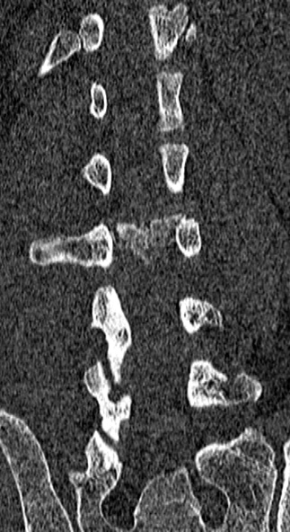 Burst fracture (Radiopaedia 53373-59357 Coronal bone window 48).jpg