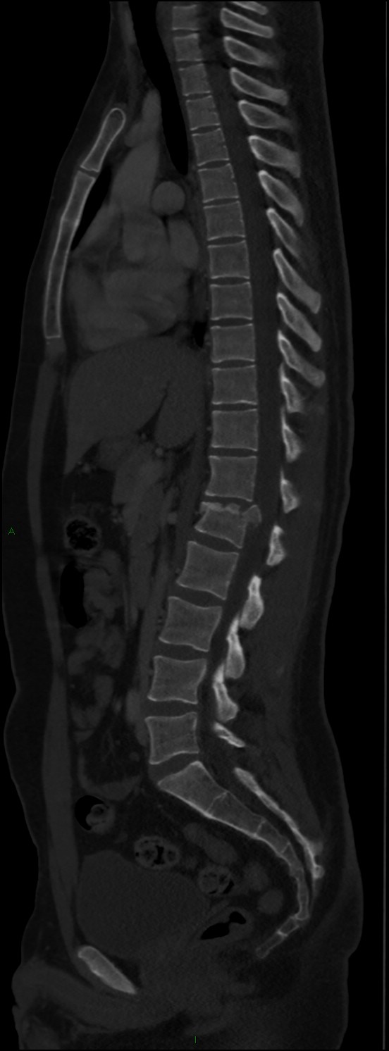 Burst fracture (Radiopaedia 83168-97542 Sagittal bone window 66).jpg