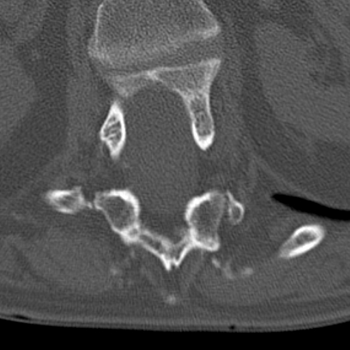 Butterfly vertebrae with kyphoscoliosis (Radiopaedia 14257-14133 Axial bone window 65).jpg