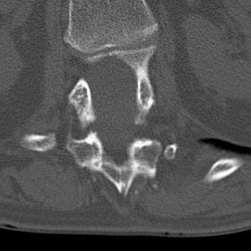 Butterfly vertebrae with kyphoscoliosis (Radiopaedia 14257-14133 Axial bone window 66).jpg