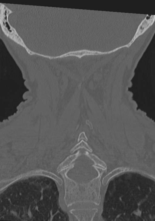 C2 fracture with vertebral artery dissection (Radiopaedia 37378-39199 Coronal bone window 40).png