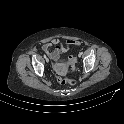 Calcified adrenal glands and Spigelian hernia (Radiopaedia 49741-54988 A 209).jpg