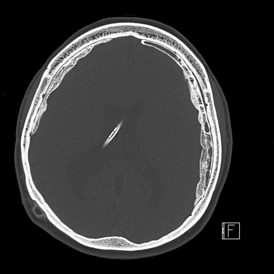 Calcified chronic subdural hematoma (Radiopaedia 77374-89492 Axial bone window 80).jpg