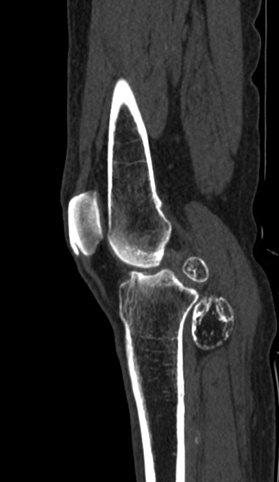 Calcified hematoma - popliteal fossa (Radiopaedia 63938-72763 Sagittal bone window 26).jpg