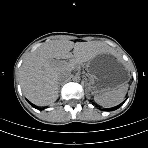 File:Calcified hepatic hydatid cyst (Radiopaedia 83870-99072 Axial non-contrast 43).jpg