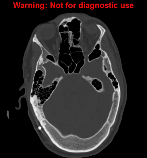 File:Calvarial thickening from chronic shunting (Radiopaedia 60079-67637 Axial bone window 58).jpg