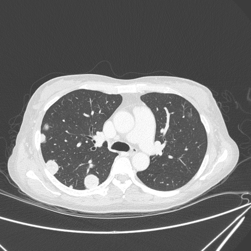 Canonball lung metastasis (Radiopaedia 77634-89837 Axial lung window 69).jpg