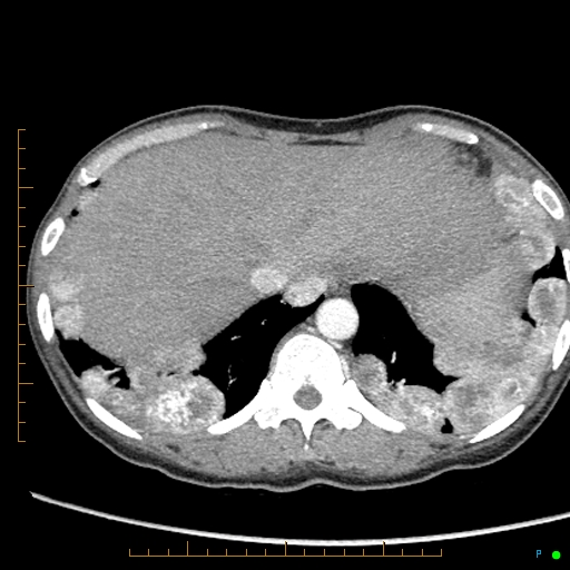 Canonball lung metastasis (Radiopaedia 77634-89837 B 87).jpg