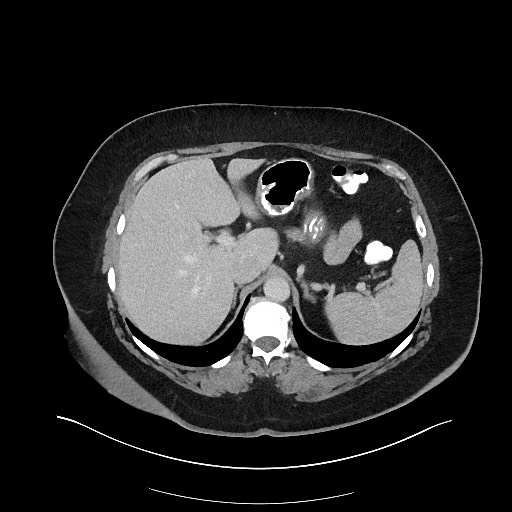 File:Carcinoid tumor - terminal ileum (Radiopaedia 60931-68739 A 32).jpg