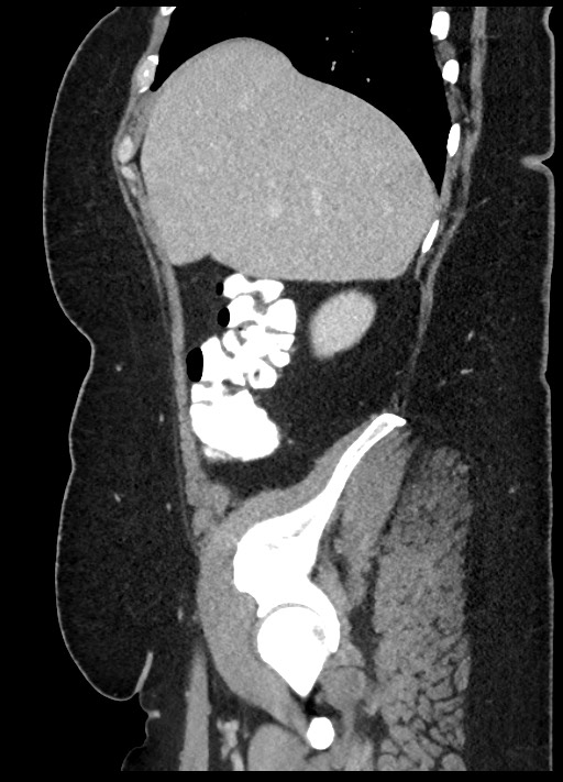 Carcinoid tumor - terminal ileum (Radiopaedia 60931-68739 C 82).jpg