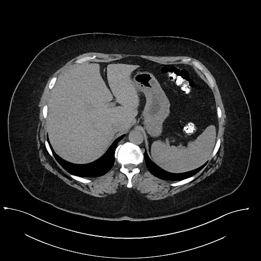 Carcinoid tumor - terminal ileum (Radiopaedia 60931-68740 Axial non-contrast 16).jpg