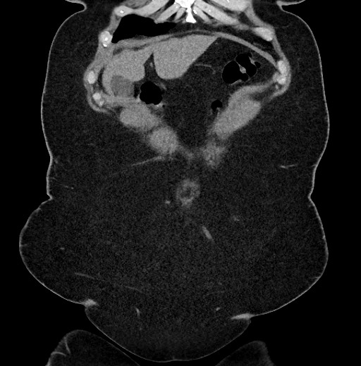 Carcinoid tumor - terminal ileum (Radiopaedia 60931-68740 Coronal non-contrast 10).jpg