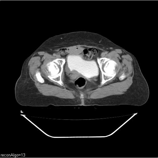 File:Carcinoma cervix- recurrence (Radiopaedia 34702-36137 B 87).jpg