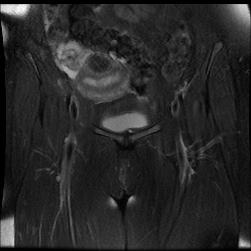 File:Carcinoma of the cervix (Radiopaedia 89018-105858 Coronal T2 fat sat 2).jpg
