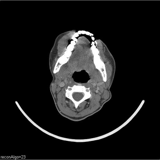 Carcinoma of the maxillary antrum (Radiopaedia 53805-59888 Axial C+ delayed 35).jpg