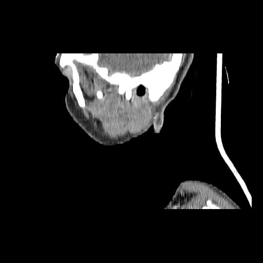 Carcinoma of the maxillary antrum (Radiopaedia 53805-59888 Sagittal C+ delayed 158).jpg