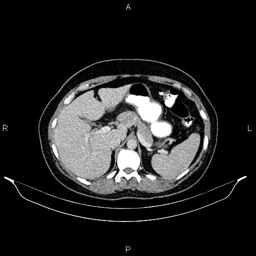 Carcinoma of uterine cervix (Radiopaedia 85861-101700 A 36).jpg