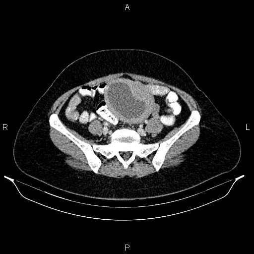 Carcinoma of uterine cervix (Radiopaedia 85861-101700 A 61).jpg