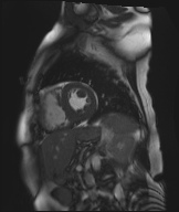 File:Cardiac amyloidosis (Radiopaedia 51404-57150 Sagittal CINE SSFP 164).jpg