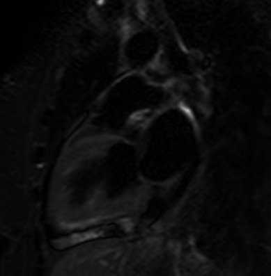 File:Cardiac sarcoidosis (Radiopaedia 74548-85466 2ch STIR 6).jpg
