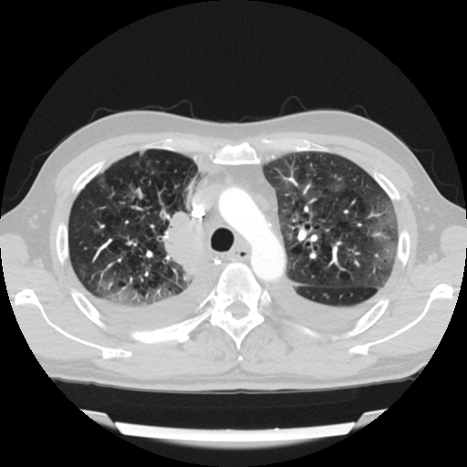 Cardiac tamponade (Radiopaedia 78607-91368 Axial lung window 21).jpg