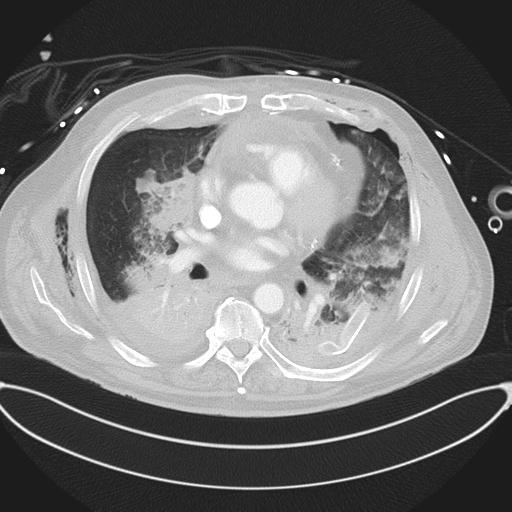 Cardiac trauma (Radiopaedia 32874-33858 Axial lung window 29).jpg