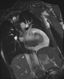 File:Cardiac tumor - undifferentiated pleomorphic sarcoma (Radiopaedia 45844-50136 Oblique T2 24).png