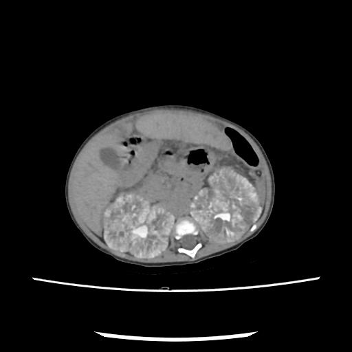 File:Caroli disease with autosomal recessive polycystic kidney disease (ARPKD) (Radiopaedia 89651-106703 E 100).jpg