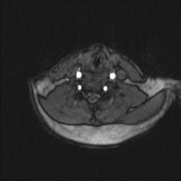 Carotid artery dissection (Radiopaedia 28441-28689 Axial MRA 27).jpg