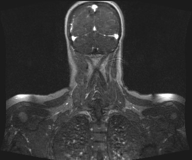 Carotid body tumor (Radiopaedia 12777-12912 MRA 65).jpg