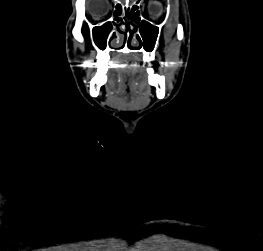 File:Carotid body tumor (Radiopaedia 83615-98727 B 24).jpg