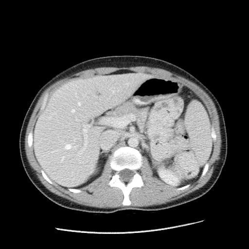 File:Castleman disease with fibrous pseudotumor in the abdomen (Radiopaedia 77296-89373 Axial 71).jpg