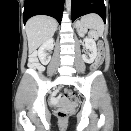 File:Castleman disease with fibrous pseudotumor in the abdomen (Radiopaedia 77296-89373 B 60).jpg