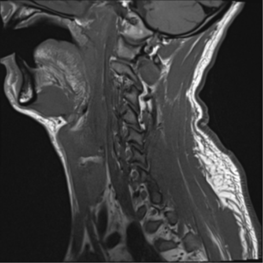 File:Cavernoma of cervical cord (Radiopaedia 50838-56347 Sagittal T1 14).png