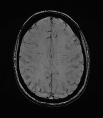 File:Cavernoma with bleed - midbrain (Radiopaedia 54546-60773 Axial SWI 33).png