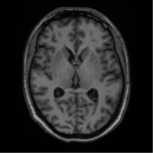 Cavernoma with bleed - midbrain (Radiopaedia 54546-60774 Axial T1 22).png